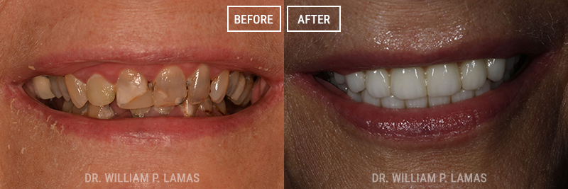 Full Teeth Replacement Before & After Photo - William P. Lamas, DMD - Periodontics & Dental Implants.
