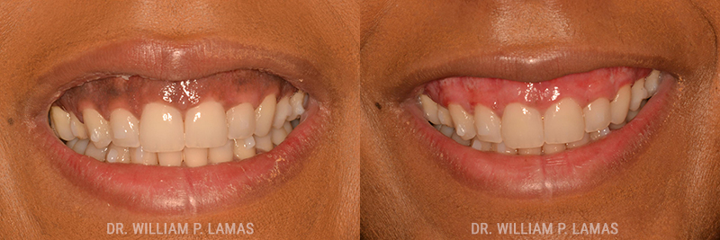 Dark Gum Depigmentation Before & After Photo - William P. Lamas, DMD - Periodontics & Dental Implants.