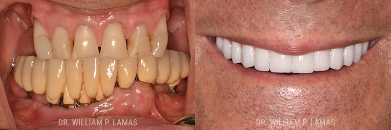 Dental Implants Repair Before & After Photo - William P. Lamas, DMD - Periodontics & Dental Implants.